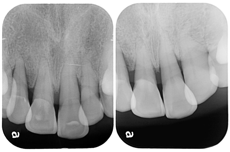 水雷射牙周病治療-案例-微創水雷射輔助牙周再生-治療後齒槽骨明顯再生