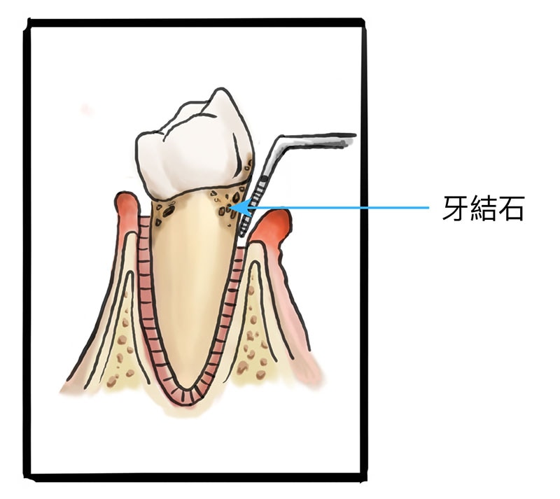 牙周病治療費用-中度牙周病-牙齦發炎-牙結石-齒槽骨萎縮-葉立維醫師-桃園牙周病