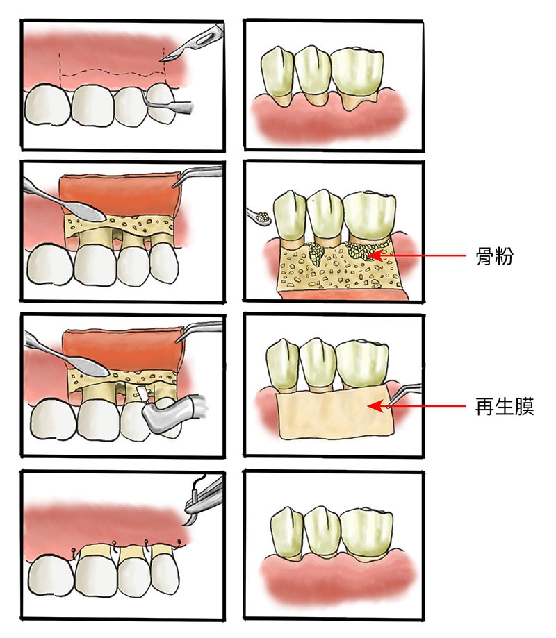 牙周病治療費用-健保-牙周翻瓣手術-自費-骨粉-再生膜-葉立維醫師-桃園牙周病