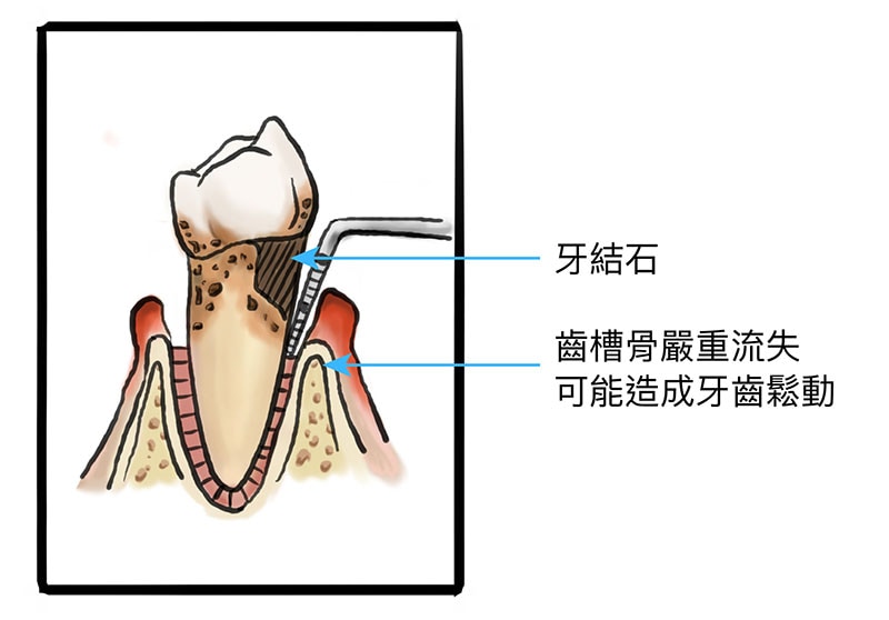 牙周病治療費用-嚴重牙周病-牙齦發炎-牙結石-齒槽骨萎縮-葉立維醫師-桃園牙周病