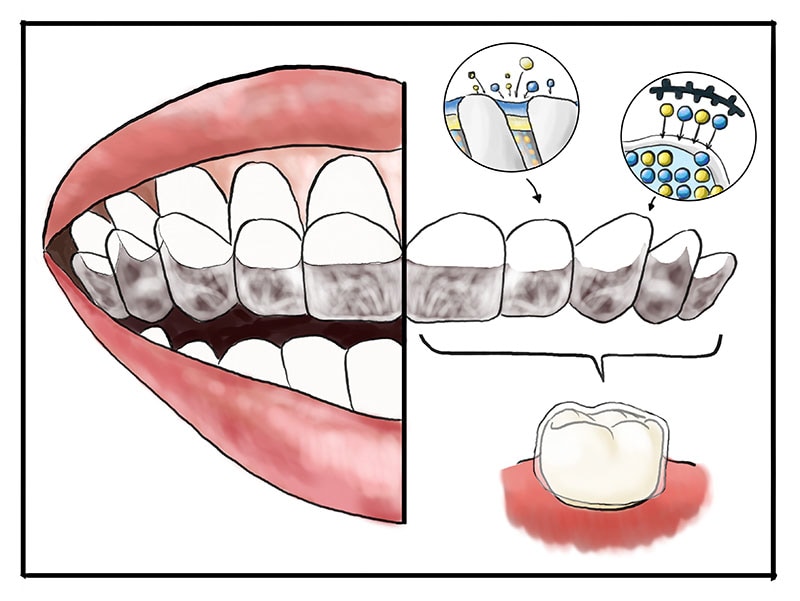 牙周病治療費用-自費-氟托-修復牙齒敏感-葉立維醫師-桃園牙周病