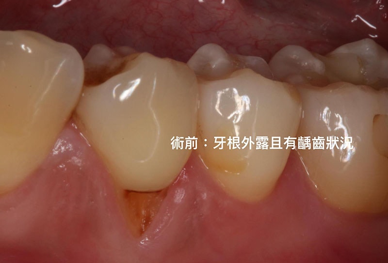 牙周病治療費用-自費-牙根覆蓋術-手術前-牙根外露-葉立維醫師-桃園牙周病