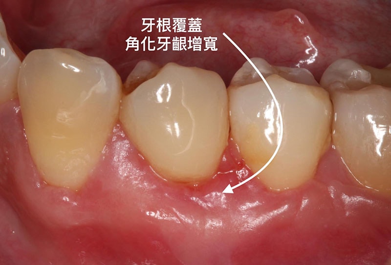 牙周病治療費用-自費-牙根覆蓋術-手術後-角化牙齦增寬-葉立維醫師-桃園牙周病