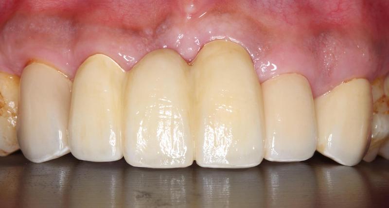 嚴重牙周病-牙周病治療-DSD微笑設計-全瓷假牙-陶瓷貼片-牙周病專科-楊梅牙周病-推薦