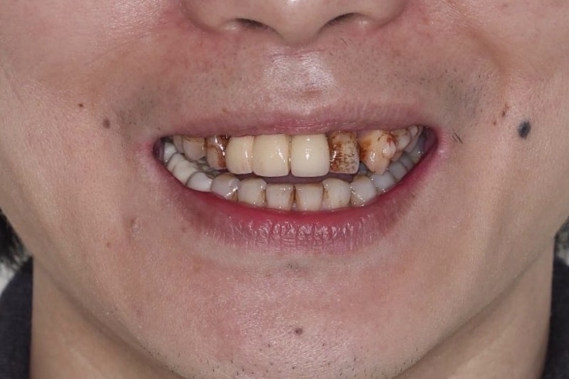 嚴重牙周病-牙周病治療-牙齒染色-舊假牙不密合-牙周病專科-楊梅牙周病-推薦