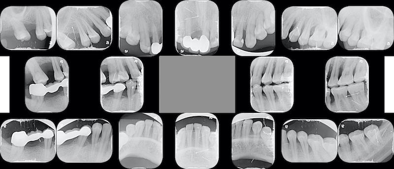 嚴重牙周病-牙周病治療-第一階段牙周病治療-全口X光片-牙周病專科-楊梅牙周病-推薦