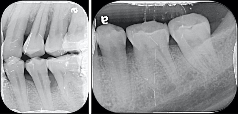 嚴重牙周病-牙周病治療-第二階段牙周再生手術-局部X光片-牙周病專科-楊梅牙周病-推薦