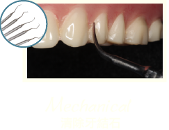 牙周病治療-牙周病治療第一階段-MAPCARE牙周病治療方案-清除牙結石-桃園牙周專科-葉立維醫師