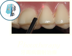 牙周病治療-牙周病治療第一階段-MAPCARE牙周病治療方案-雷射牙周病-桃園牙周專科-葉立維醫師