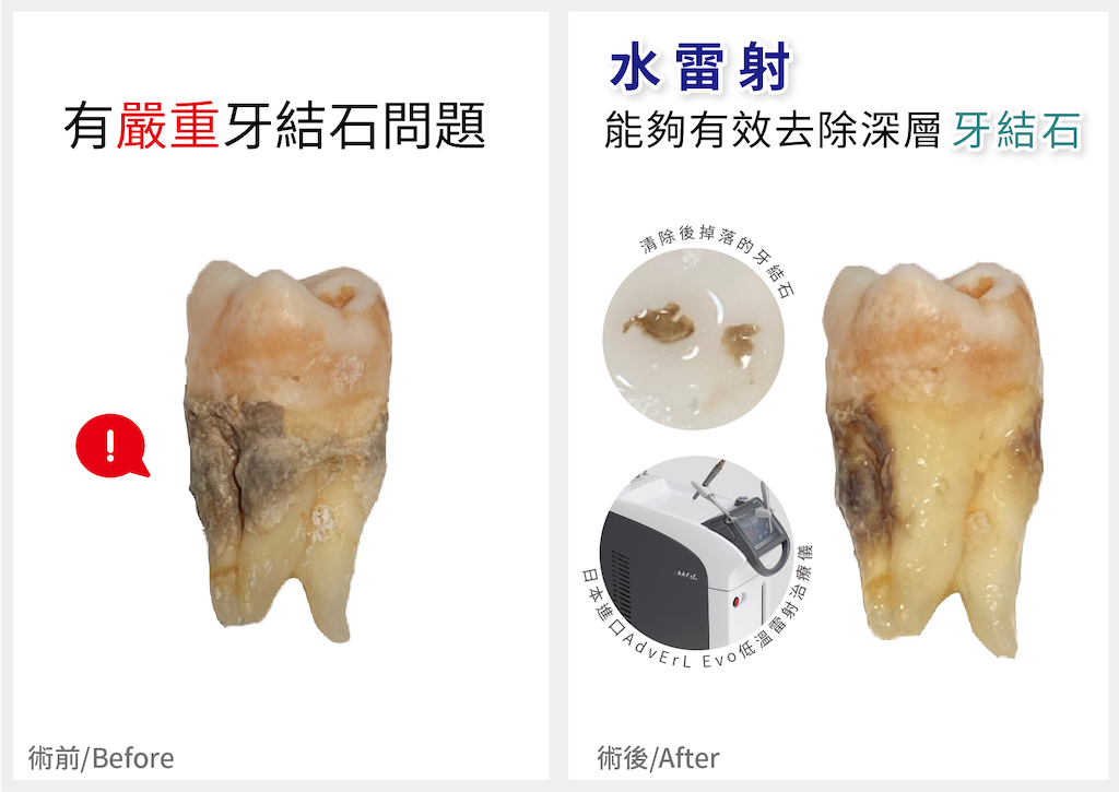 水雷射-牙周病-牙結石清除-效果