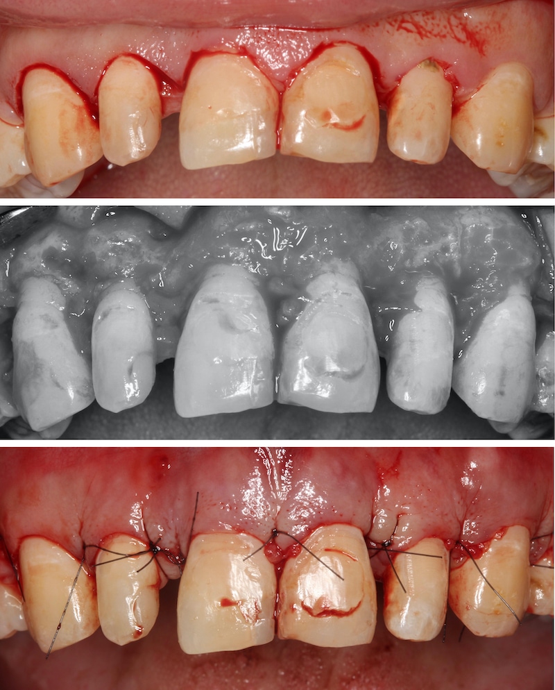 水雷射牙齦-陶瓷貼片-傳統牙冠增長術-手術過程-葉立維醫師-桃園