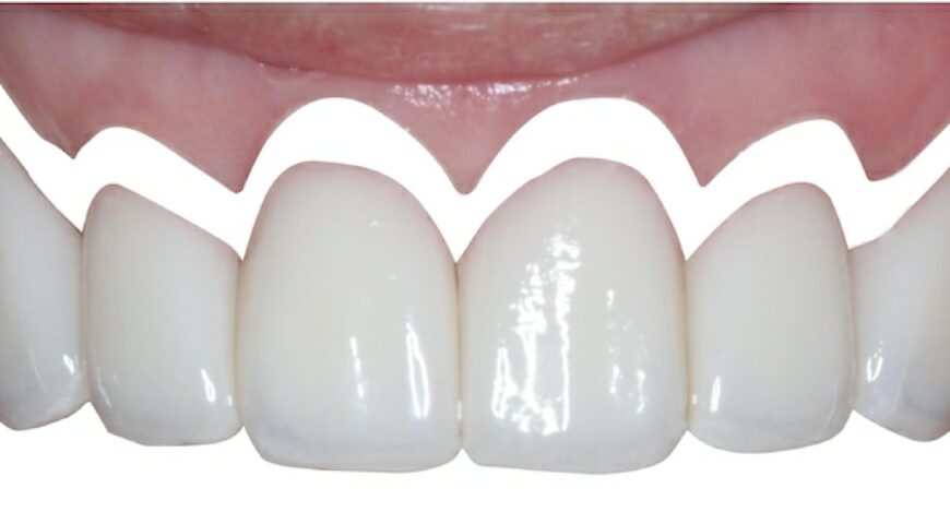 微創水雷射牙齦整形推薦: 牙齦萎縮治療/牙冠增長術/陶瓷貼片/DSD