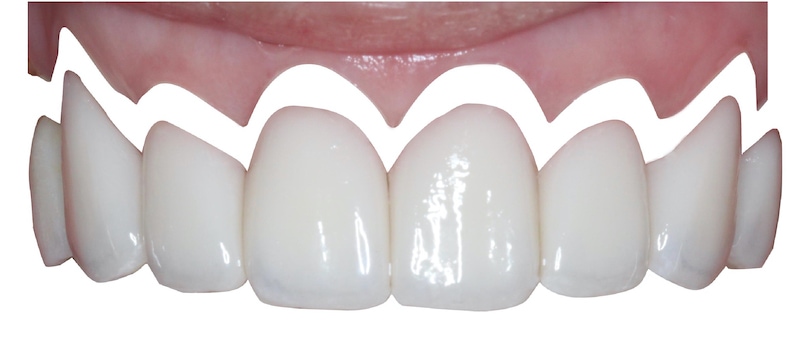 微創水雷射牙齦整形推薦: 牙齦萎縮治療/牙冠增長術/陶瓷貼片/DSD