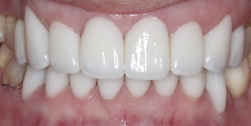 水雷射牙齦-陶瓷貼片-全瓷冠-治療後前牙外觀-葉立維醫師-桃園