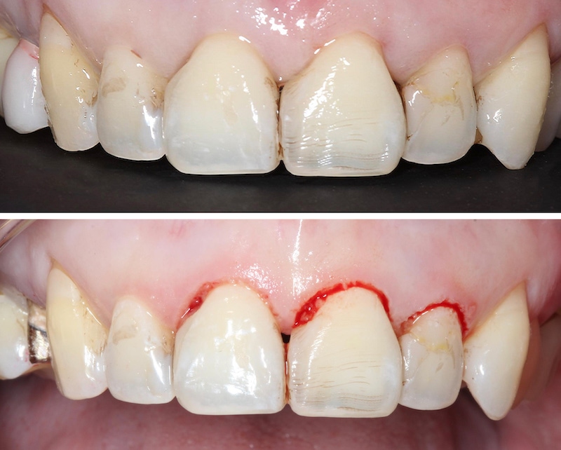 水雷射牙齦-陶瓷貼片-微創-水雷射-牙冠增長術-手術過程-葉立維醫師-桃園