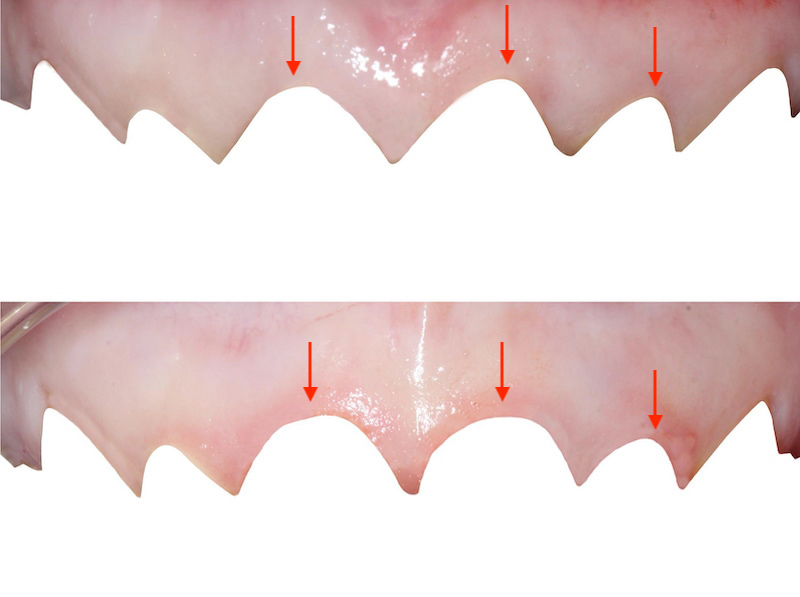 水雷射牙齦-陶瓷貼片-水雷射牙冠增長術-手術前後牙齦曲線比較-葉立維醫師-桃園