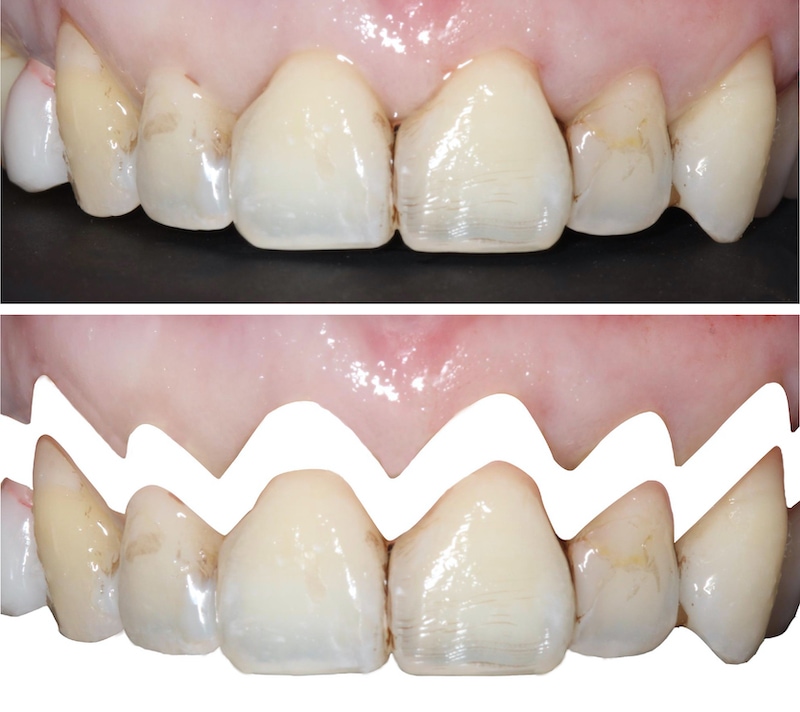水雷射牙齦-陶瓷貼片-治療前-上排前牙牙齦和牙齒型態-葉立維醫師-桃園