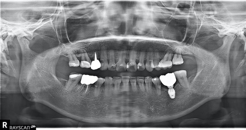 水雷射牙齦-陶瓷貼片-治療前-全口X光照-葉立維醫師-桃園