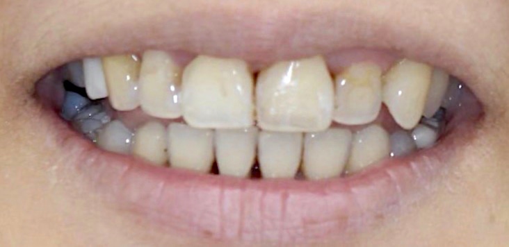 水雷射牙齦-陶瓷貼片-治療前-前牙正面照-葉立維醫師-桃園