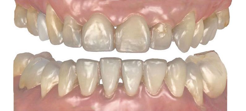 水雷射牙齦-陶瓷貼片-治療前-數位口掃牙齒模型-葉立維醫師-桃園