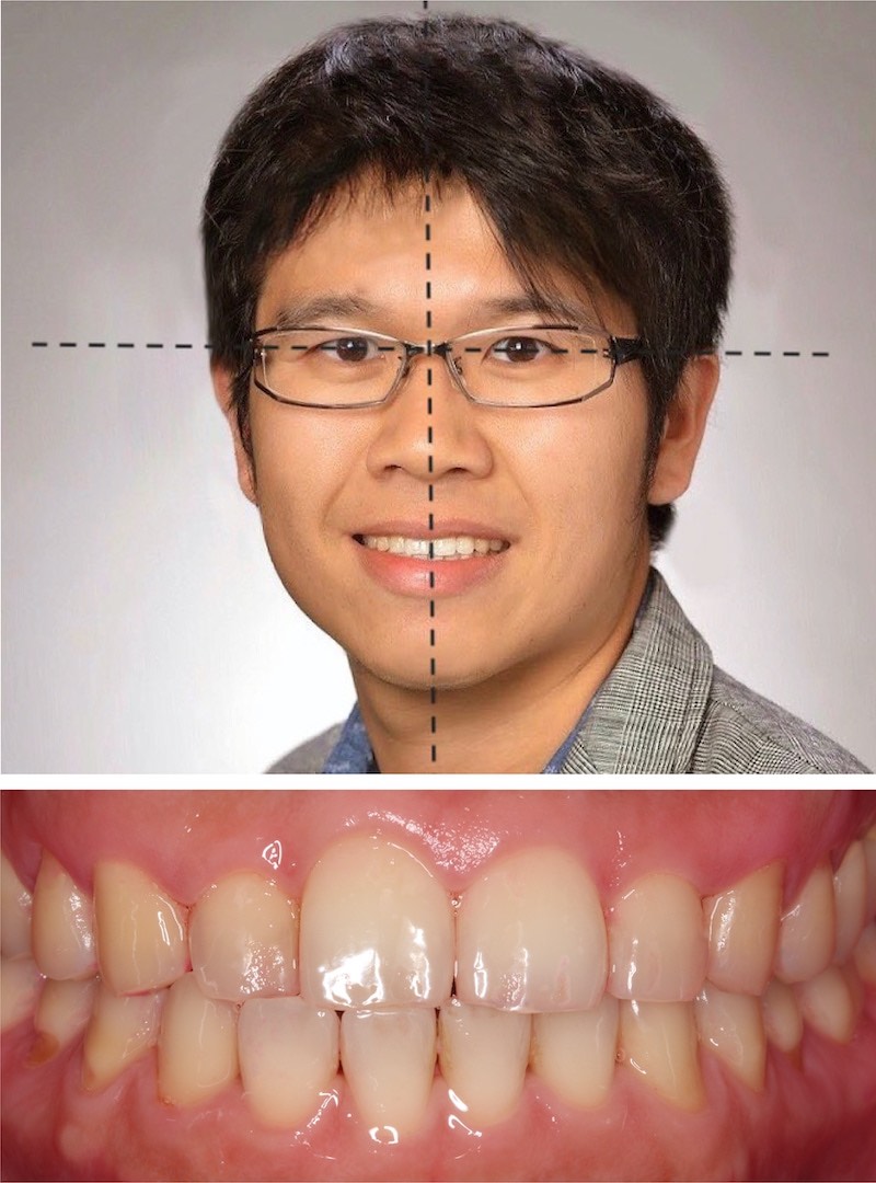 水雷射牙齦-陶瓷貼片-牙齒中線與門牙位置協調性說明示意圖-葉立維醫師-桃園
