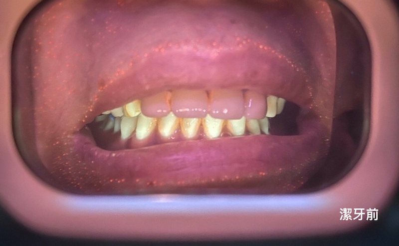 牙周病專科-牙周病專科醫師-牙周病檢查-I-Cute牙菌斑檢測儀-潔牙前-葉立維醫師-桃園