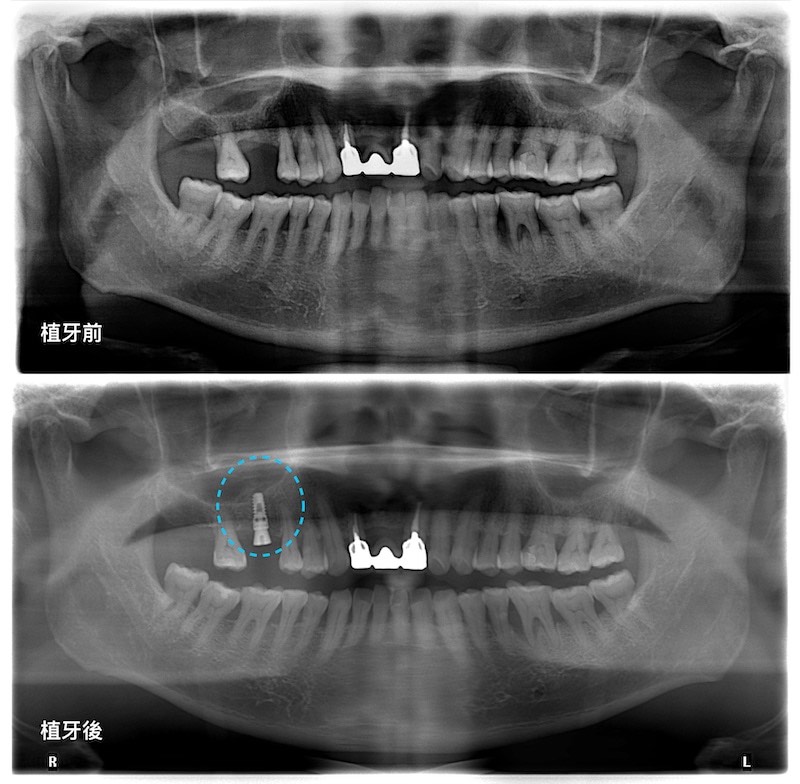 鼻竇增高術-內部鼻竇增高術-植牙補骨前後-右上第一大臼齒-上顎植牙-成功率-葉立維醫師-桃園