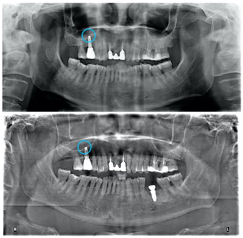 鼻竇增高術-內部鼻竇增高術-植牙補骨後追蹤-右上第一大臼齒-新骨生成-1-上顎植牙-成功率-葉立維醫師-桃園