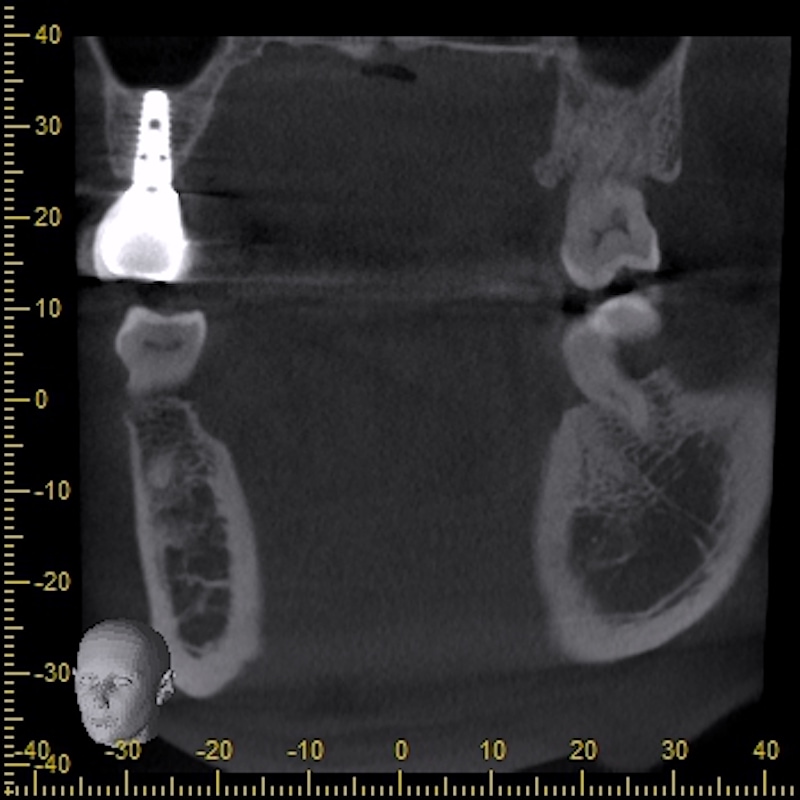 鼻竇增高術-內部鼻竇增高術-植牙補骨後追蹤-右上第一大臼齒-新骨生成-2-上顎植牙-成功率-葉立維醫師-桃園