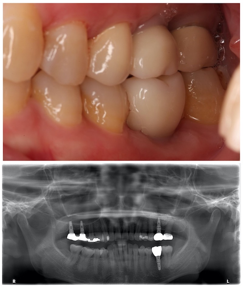 鼻竇增高術-外部鼻竇增高術-植牙補骨後-左上後牙-植牙假牙-上顎植牙-成功率-葉立維醫師-桃園