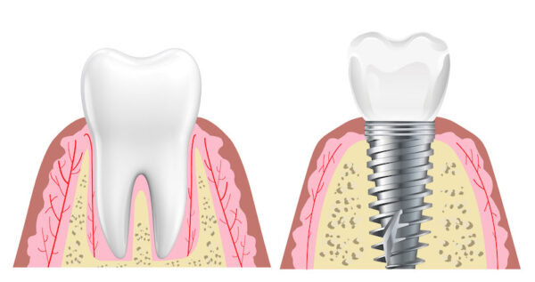 植體周圍炎-正常牙齒與植體結構比較圖-葉立維醫師