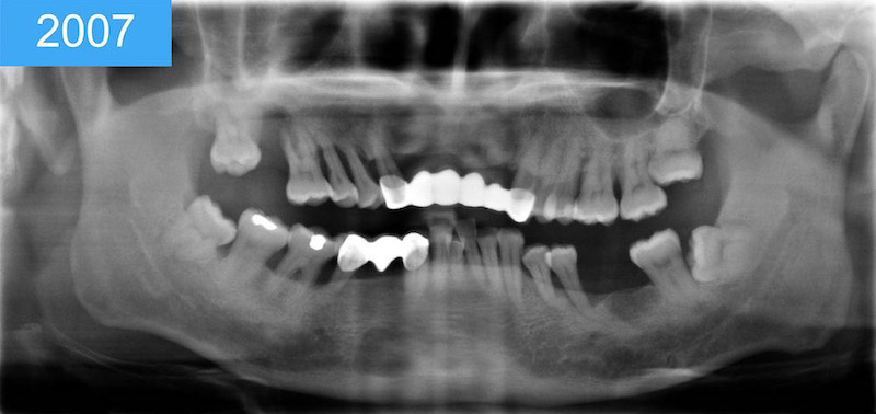 植體周圍炎-治療案例-嚴重牙周病-2007全口X光片-葉立維醫師