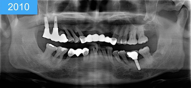 植體周圍炎-治療案例-嚴重牙周病-2010全口X光片-葉立維醫師