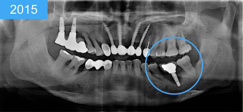 植體周圍炎-治療案例-嚴重牙周病-植牙處齒槽骨流失-2015全口X光片-葉立維醫師