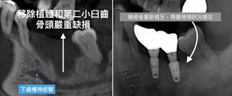 植體周圍炎-治療案例-移除植體補骨後重新植牙-治療前後X光片-葉立維醫師