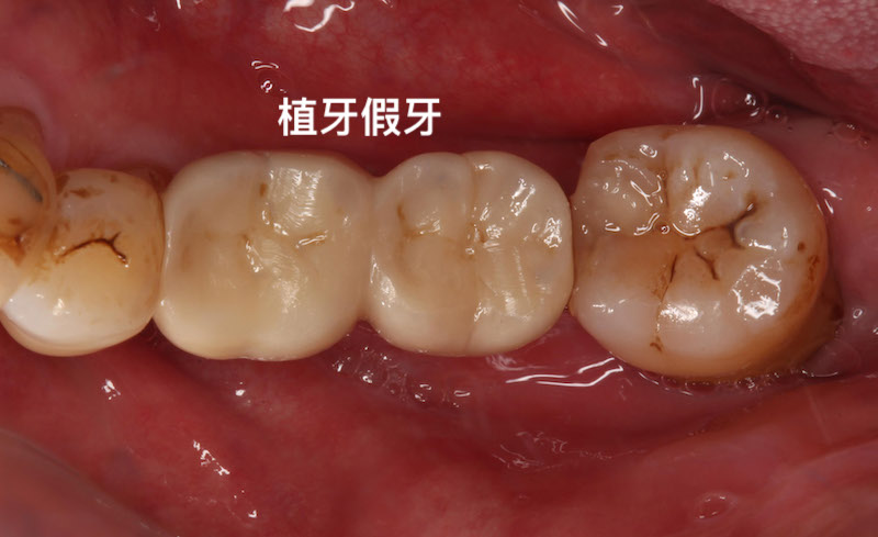 植體周圍炎-治療案例-重新植牙-治療後假牙外觀-葉立維醫師
