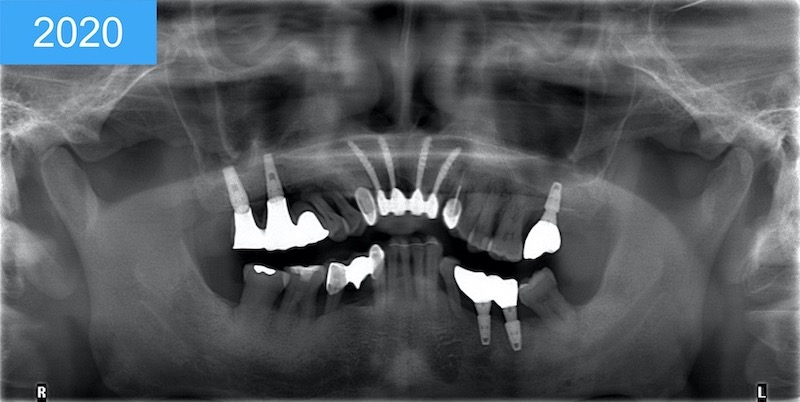 植體周圍炎-治療案例-重新植牙-治療後全口X光片-葉立維醫師