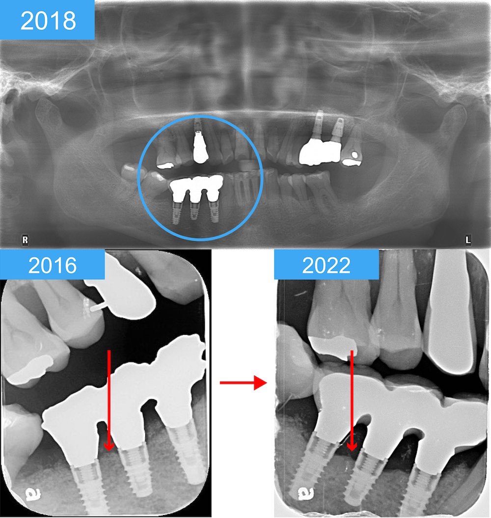 牙周病植牙-嚴重牙周病植牙後未定期檢查發現骨吸收-牙周病專科醫師-葉立維醫師-桃園