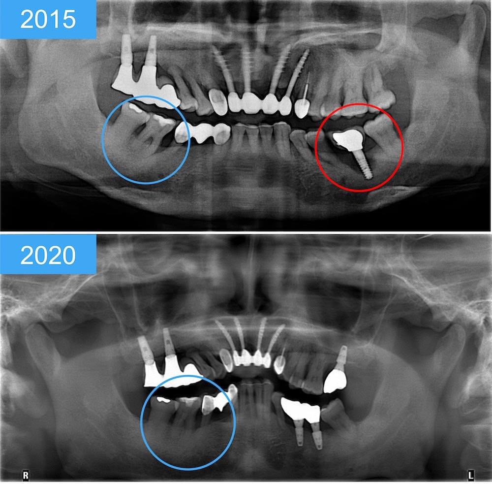 牙周病植牙-追蹤比較嚴重牙周病臼齒和植牙存活情形-牙周病專科醫師-葉立維醫師-桃園