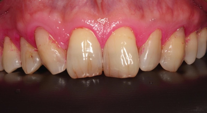 陶瓷貼片療程前的上排牙齒近照，較尖的犬齒也影響微笑曲線對稱性