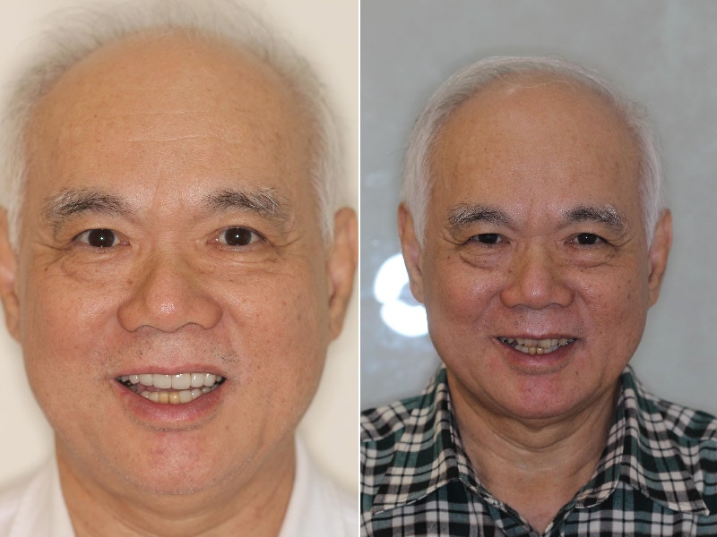 陶瓷貼片修復前牙美觀的前後比較，治療後患者笑容更顯年輕