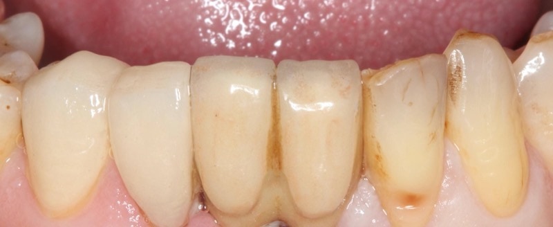 植牙假牙右邊兩顆側門牙，在陶瓷貼片修復後恢復美觀的外表