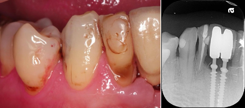 植牙假牙右側的口內照及局部X光片，可看出根管治療和樹脂填補痕跡