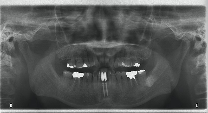 植牙後假牙牙齦發炎，患者的環口全景X光片