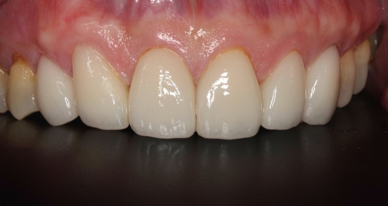 採六顆陶瓷貼片治療後的上排牙齒近照，大幅恢復美觀和對稱性