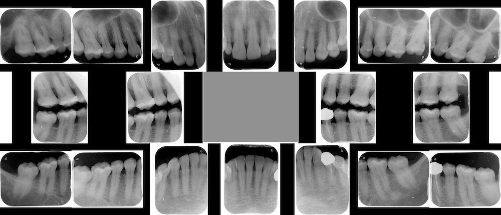 水雷射牙周病治療前全口X光片，顯示患者牙周齒槽骨呈現中度流失