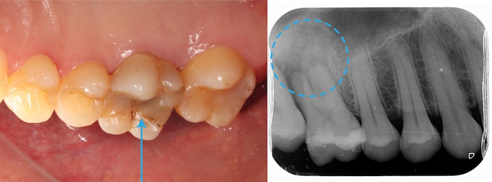 水雷射牙周病治療前口腔照與X光片，照片顯示右上第一大臼齒樹脂填補邊緣已呈現不密合，有二次蛀牙的現象；X光片顯示牙根周圍齒槽骨嚴重破壞，導致患者產生咬合無力的感覺