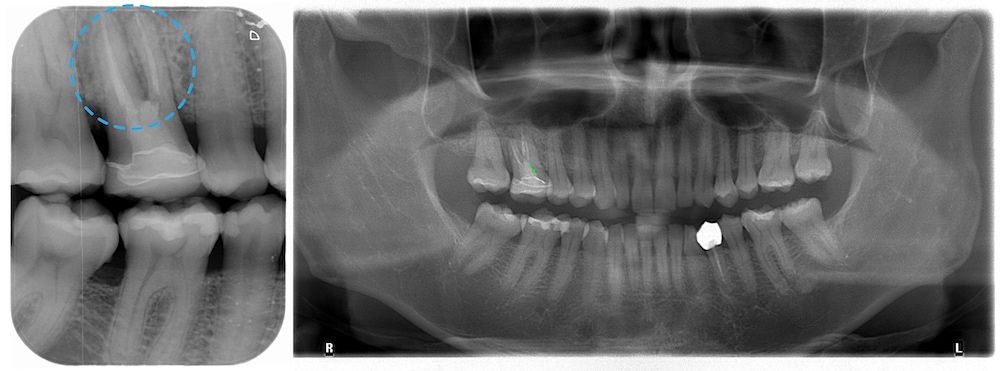 完成水雷射牙周病治療、第二階段牙周再生手術後X光片，改善牙根分岔處較深的牙周囊袋和齒槽骨缺損，術後恢復良好