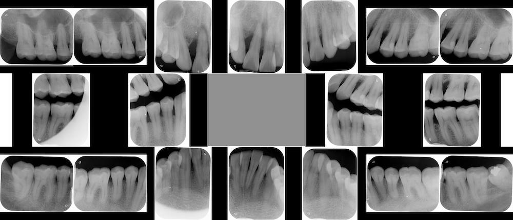 水雷射牙周病治療前全口X光片，除了上顎門牙區齒槽骨破壞，其他區域也有牙周齒槽骨的流失現象