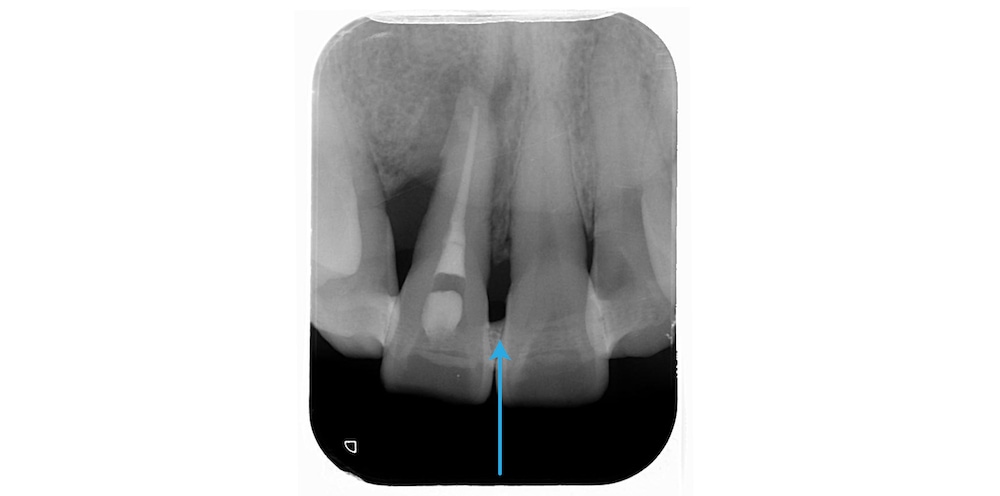 水雷射牙周病治療後門牙X光片，經齒間固定術、牙周治療與根管治療後部分牙周自然再生